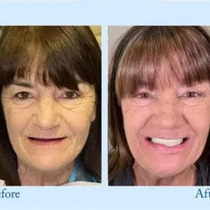 𝐇𝐢𝐝𝐨𝐧𝐞® 𝐏𝐫𝐞𝐦𝐢𝐮𝐦 𝐃𝐞𝐧𝐭𝐮𝐫𝐞