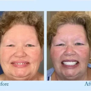 𝐇𝐢𝐝𝐨𝐧𝐞® 𝐏𝐫𝐞𝐦𝐢𝐮𝐦 𝐃𝐞𝐧𝐭𝐮𝐫𝐞