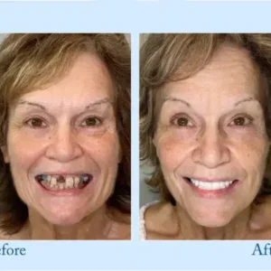 𝐇𝐢𝐝𝐨𝐧𝐞® 𝐏𝐫𝐞𝐦𝐢𝐮𝐦 𝐃𝐞𝐧𝐭𝐮𝐫𝐞