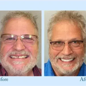 𝐇𝐢𝐝𝐨𝐧𝐞® 𝐏𝐫𝐞𝐦𝐢𝐮𝐦 𝐃𝐞𝐧𝐭𝐮𝐫𝐞