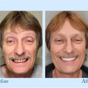 𝐇𝐢𝐝𝐨𝐧𝐞® 𝐏𝐫𝐞𝐦𝐢𝐮𝐦 𝐃𝐞𝐧𝐭𝐮𝐫𝐞