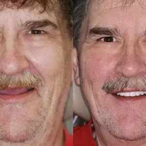 HZA™ Advanced Customized Full Denture Set