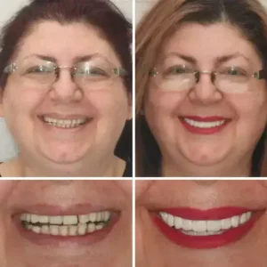 HZA™ Advanced Customized Full Denture Set