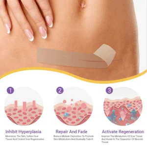 ✅Official Store |SEAGRIL® Hyaluronic Acid Nano Microneedle Repair Tape🏥(Treatment of old and new scars, reduction of surgical scars, stretch marks, keloids, acne, burns, warts, dermatomes and varicose veins)