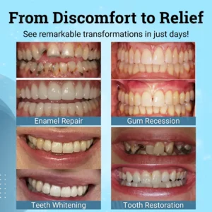 AEXZR® Non-Surgical Gum 