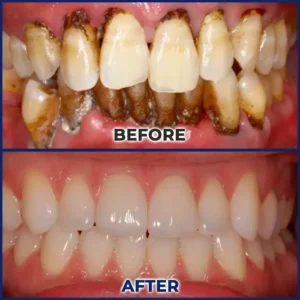 Newyou® Bee Venom Dental Treatment Drops Mouthwash