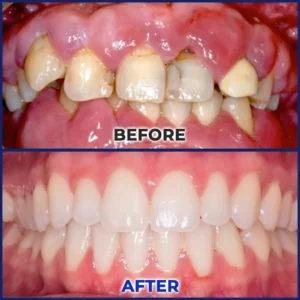 Newyou® Bee Venom Dental Treatment Drops Mouthwash