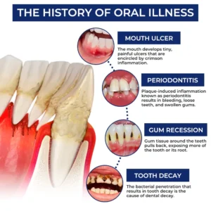Newyou® Bee Venom Dental Treatment Drops Mouthwash
