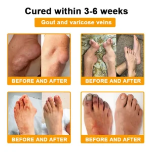 SEAGRIL™ Botulinum Toxin & Bee Venom Pain-Relief Bone Healing Cream