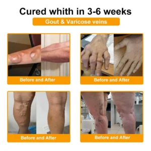 SEAGRIL™ Botulinum Toxin & Bee Venom Pain-Relief Bone Healing Cream