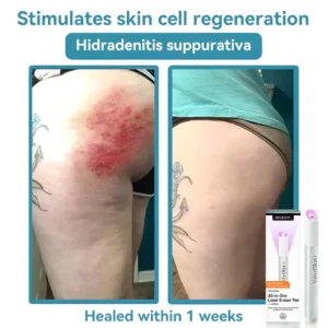 Seurico™ VelvetSkin+ All-in-One Laser Eraser Pen