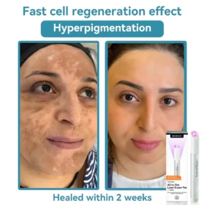 Seurico™ VelvetSkin+ All-in-One Laser Eraser Pen