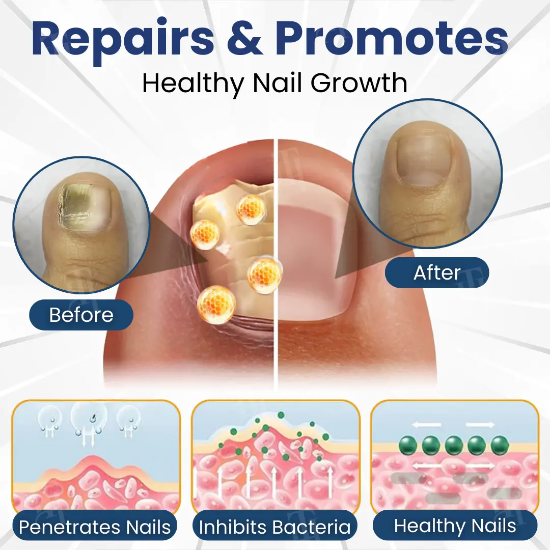 AEXZR® Bio-Active Deep Penetration System for Nail Fungus