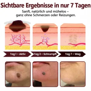 KUBOZN® OryzaDarts TAG’GONE – Schmerzfreie Entfernung an der Wurzel dank Schwarzer-Reis-Mikrotechnologie ✨
