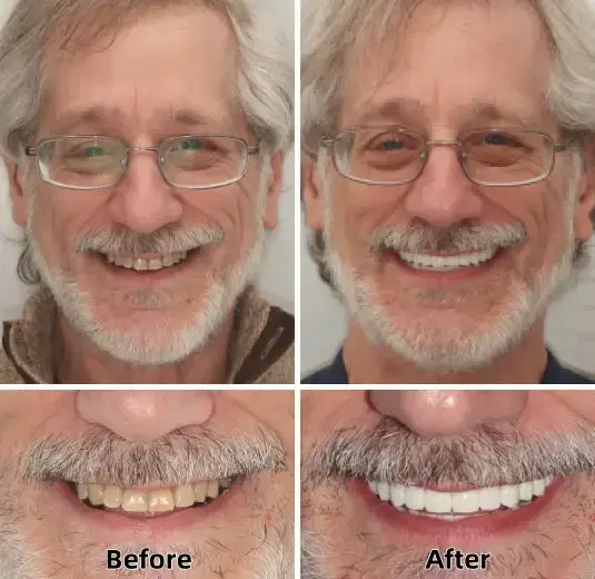 SmileFitPro™–Advanced Custom-Fit Functional Dentures