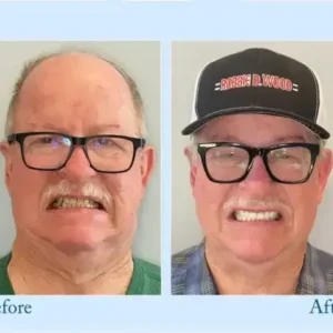 Hidone™ – Premium-Zahnprothese