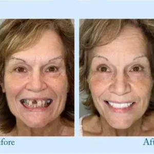 Hidone™ – Premium-Zahnprothese