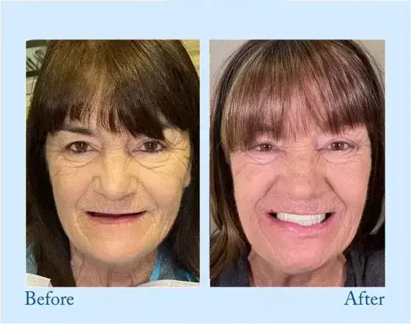 Hidone™ – Premium-Zahnprothese