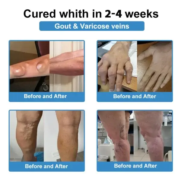 ✅ Official Store: Skavix® Nano-Microneedle Joint Patch