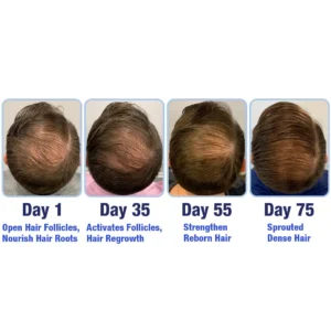 🍉Cougex™ PotentGRO Hair Treatment Roller