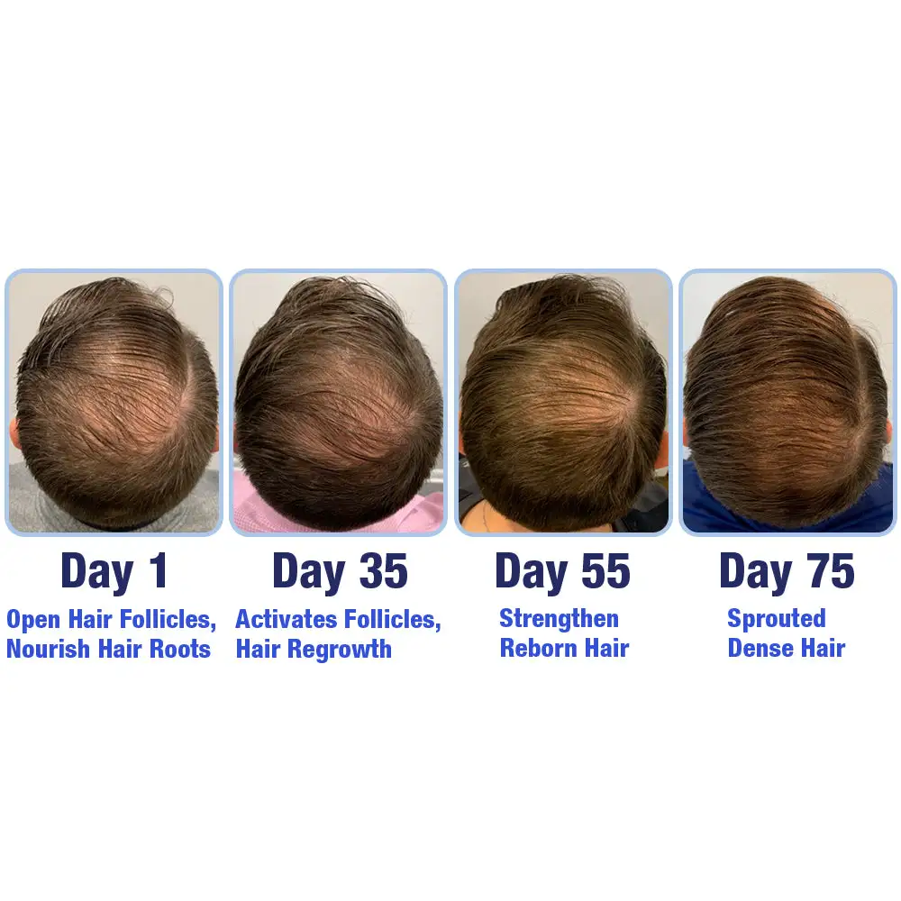 🍉Cougex™ PotentGRO Hair Treatment Roller