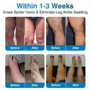 🇬🇧👨‍⚕️✅👍GFOUK® VeinRepair Microneedle Patch Roll⚡Instant Relief, Long-Term Results