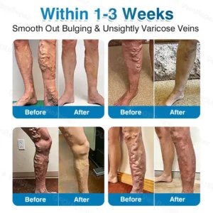 🇬🇧👨‍⚕️✅👍GFOUK® VeinRepair Microneedle Patch Roll⚡Instant Relief, Long-Term Results