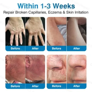 🇬🇧👨‍⚕️✅👍GFOUK® VeinRepair Microneedle Patch Roll⚡Instant Relief, Long-Term Results