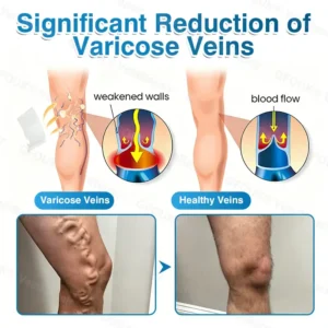 🇬🇧👨‍⚕️✅👍GFOUK® VeinRepair Microneedle Patch Roll⚡Instant Relief, Long-Term Results