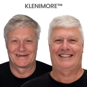 ⏰ KLENIMORE™ Custom-Fit Dentures ENDS TODAY 70% OFF | Smile with Confidence