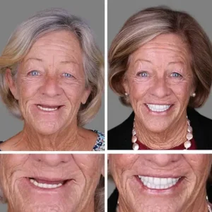 2026 KLENIMORE™ Full Denture | Secure Suction Fit