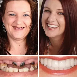 🏆Ends Today: 70% OFF! 🏆2026 Bestselling Product🦷 Fit for a Fresh Smile, Say Goodbye to Wearing Discomfort!🌎