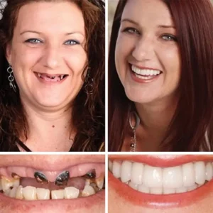 -Ends Today: 70% OFF! ⏰HazyGalaxy™ Medical Full Denture with Strong Suctiond Custom-Fit Full Functional Dentures🦷
