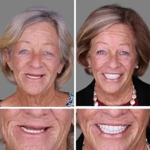 -Ends Today: 70% OFF! ⏰HazyGalaxy™ Medical Full Denture with Strong Suctiond Custom-Fit Full Functional Dentures🦷
