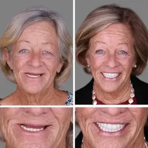 ⏰Ends Today: 70% OFF! 🌎KLENIMORE™ Custom-Fit Dentures— Designed for Comfort and a Natural-Looking Smile