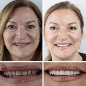 --Ends Today: 75% OFF! ⏰DarkFairy™ Medical Full Denture with Strong Suctiond Custom-Fit Full Functional Dentures🦷