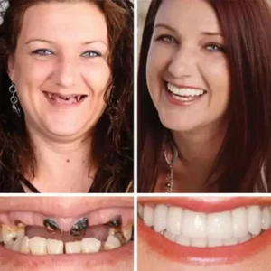 Ends Today: 75% OFF! ⏰FOMONEST™ Full Denture with Strong Suctiond Custom-Fit Full Functional Dentures🦷