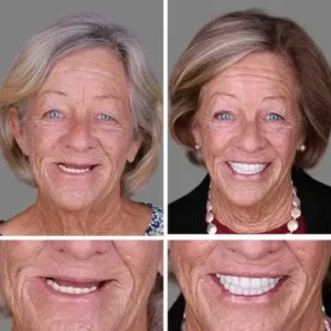 Ends Today: 75% OFF! ⏰FOMONEST™ Full Denture with Strong Suctiond Custom-Fit Full Functional Dentures🦷