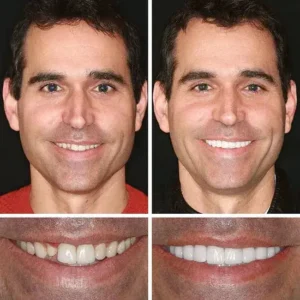 KLENIMORE™ Custom Dentures 2026 | Secure Natural Fit