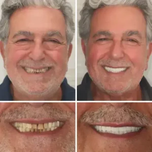 【Official Brand Store】Custom-Fit Functional Dentures — ComfortMax Edition