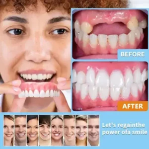 【Official Brand Store】Custom-Fit Functional Dentures — ComfortMax Edition