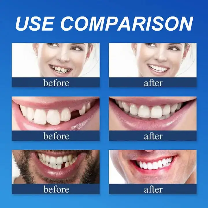 🔥Today's Special: 70% Off!(Affordable Beauty🧏♀️🧏♂️)--KLENIMORE™ --Advanced Customized Full Denture Set🦷