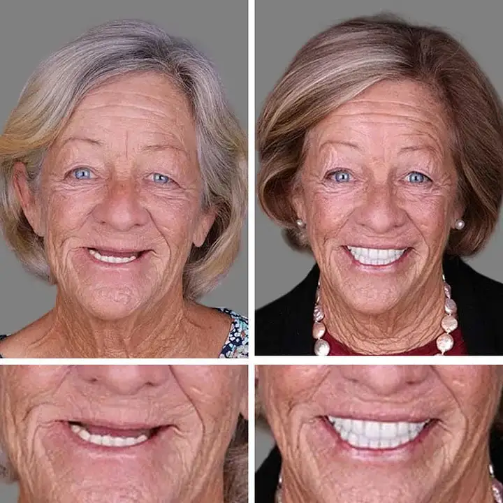 🔥Today's Special: 70% Off!(Affordable Beauty🧏♀️🧏♂️)--KLENIMORE™ --Advanced Customized Full Denture Set🦷