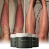 Vexiray™ Eczema & Psoriasis Cream