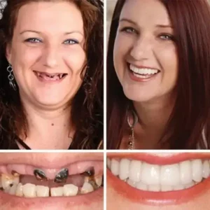 2026 Custom-Fit Full Denture with Strong Suction