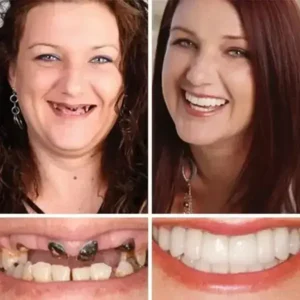 Heaceitr® Premium Full Denture Set