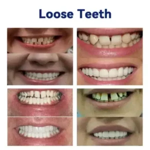 https://skavix.net/product/vaxflite-full-denture-set-upper-lower/