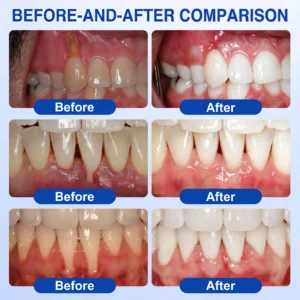 Glimmerly® GumRevive Periodontal Repair Gel
